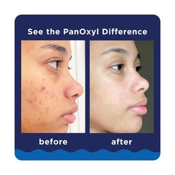 PanOxyl Acne Foaming Wash Benzoyl Peroxide 10% Maximum Strength - (156)g