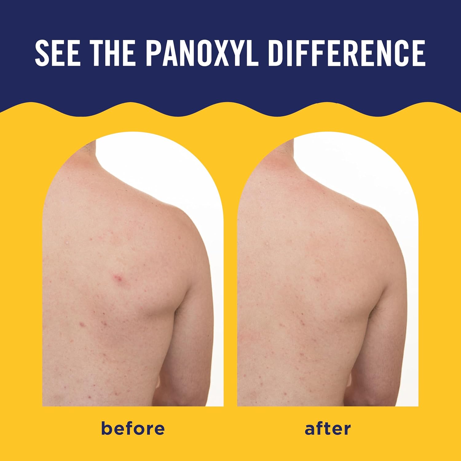 PanOxyl Acne Banishing Body Spray With 2% Salicylic Acid 170g